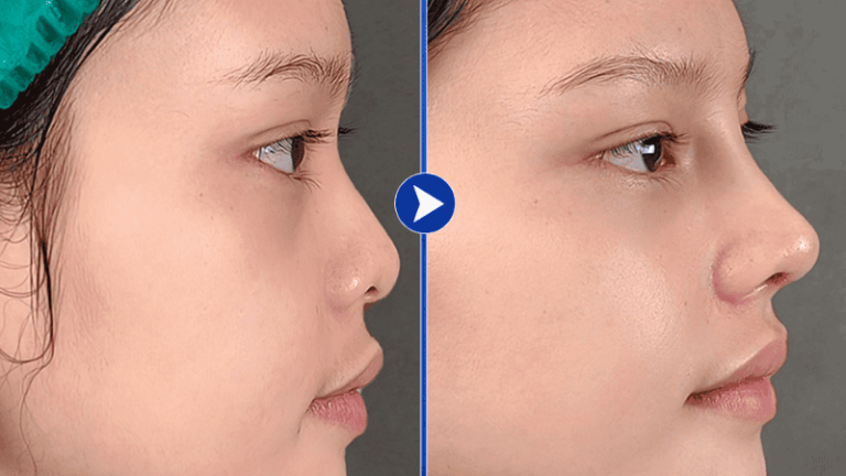 Khách hàng review dịch vụ nâng mũi bệnh viện Sao Hàn